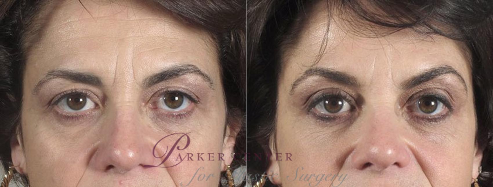 Nonsurgical Face Procedures Case 292 Before & After View #1 | Paramus, New Jersey | Parker Center for Plastic Surgery