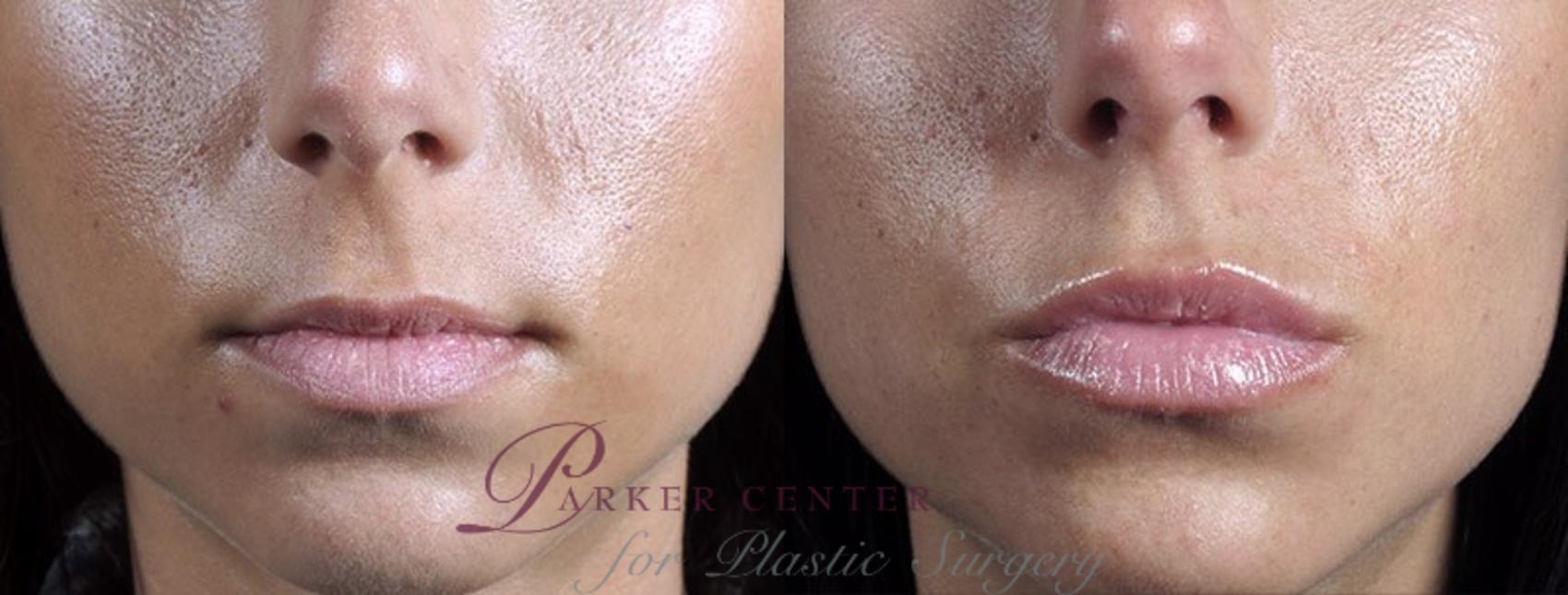 Nonsurgical Face Procedures Case 301 Before & After View #1 | Paramus, New Jersey | Parker Center for Plastic Surgery
