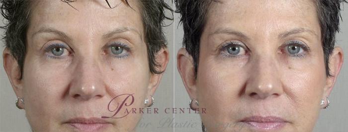 Nonsurgical Face Procedures Case 307 Before & After View #1 | Paramus, New Jersey | Parker Center for Plastic Surgery
