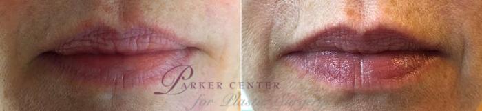 Dermal Fillers Case 334 Before & After View #1 | Paramus, New Jersey | Parker Center for Plastic Surgery