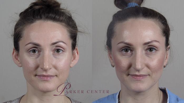Ear Surgery Case 1019 Before & After Front | Paramus, NJ | Parker Center for Plastic Surgery