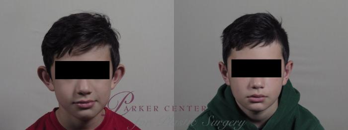Ear Surgery Case 1205 Before & After View #1  | Paramus, NJ | Parker Center for Plastic Surgery