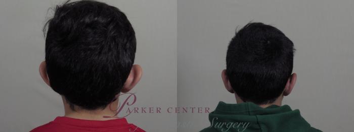 Ear Surgery Case 1205 Before & After View #2  | Paramus, NJ | Parker Center for Plastic Surgery