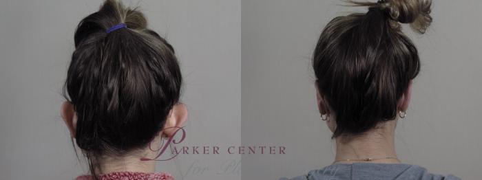 Otoplasty Case 1229 Before & After View #2 | Paramus, NJ | Parker Center for Plastic Surgery