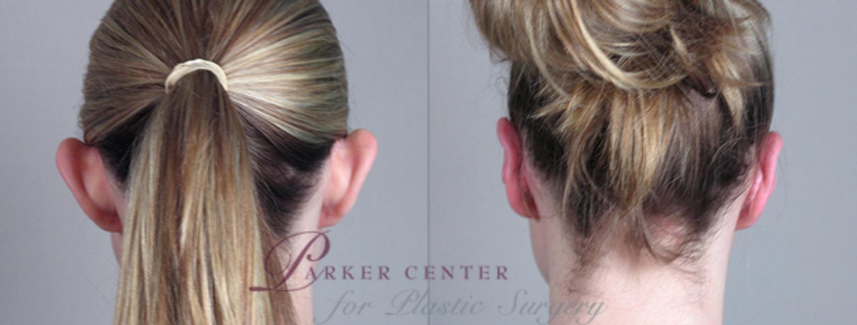 Ear Surgery Case 233 Before & After View #1 | Paramus, NJ | Parker Center for Plastic Surgery