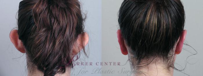 Ear Surgery Case 234 Before & After View #1 | Paramus, NJ | Parker Center for Plastic Surgery