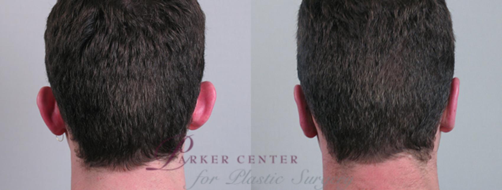 Ear Surgery Case 236 Before & After View #1 | Paramus, NJ | Parker Center for Plastic Surgery
