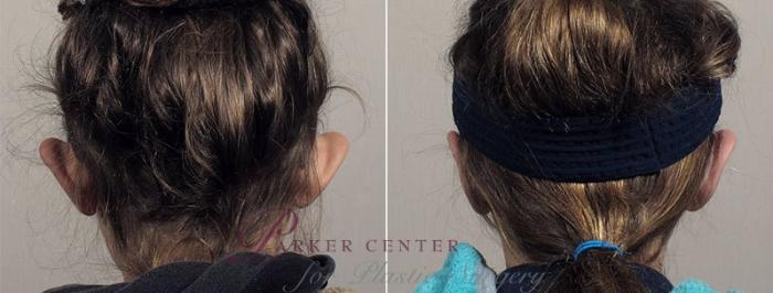 Ear Surgery Case 245 Before & After View #2 | Paramus, NJ | Parker Center for Plastic Surgery