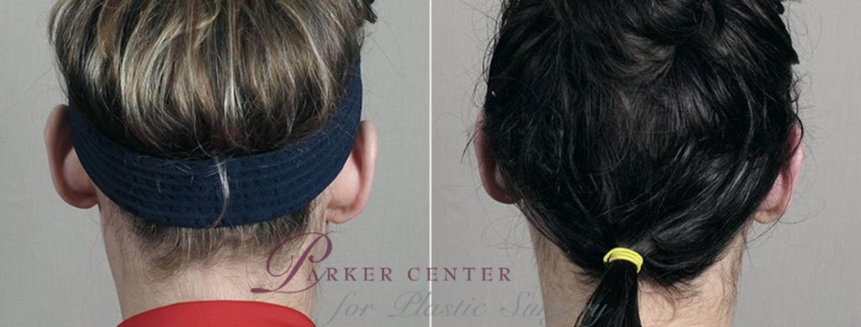 Ear Surgery Case 247 Before & After View #1 | Paramus, NJ | Parker Center for Plastic Surgery