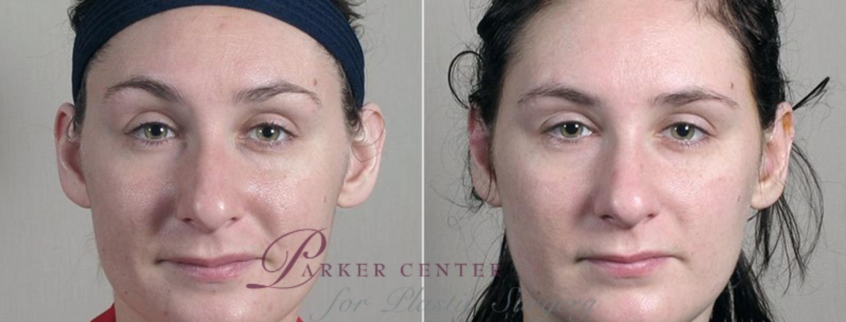 Ear Surgery Case 247 Before & After View #2 | Paramus, NJ | Parker Center for Plastic Surgery