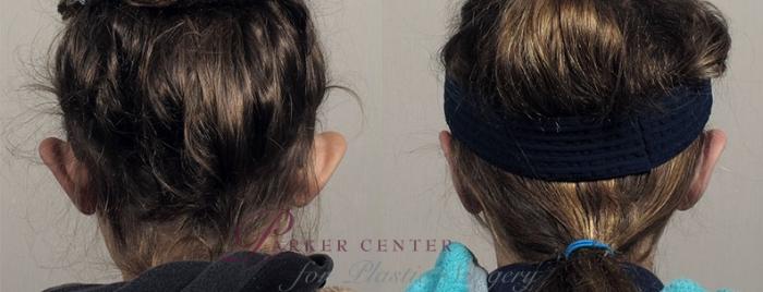 Ear Surgery Case 895 Before & After View #4 | Paramus, NJ | Parker Center for Plastic Surgery