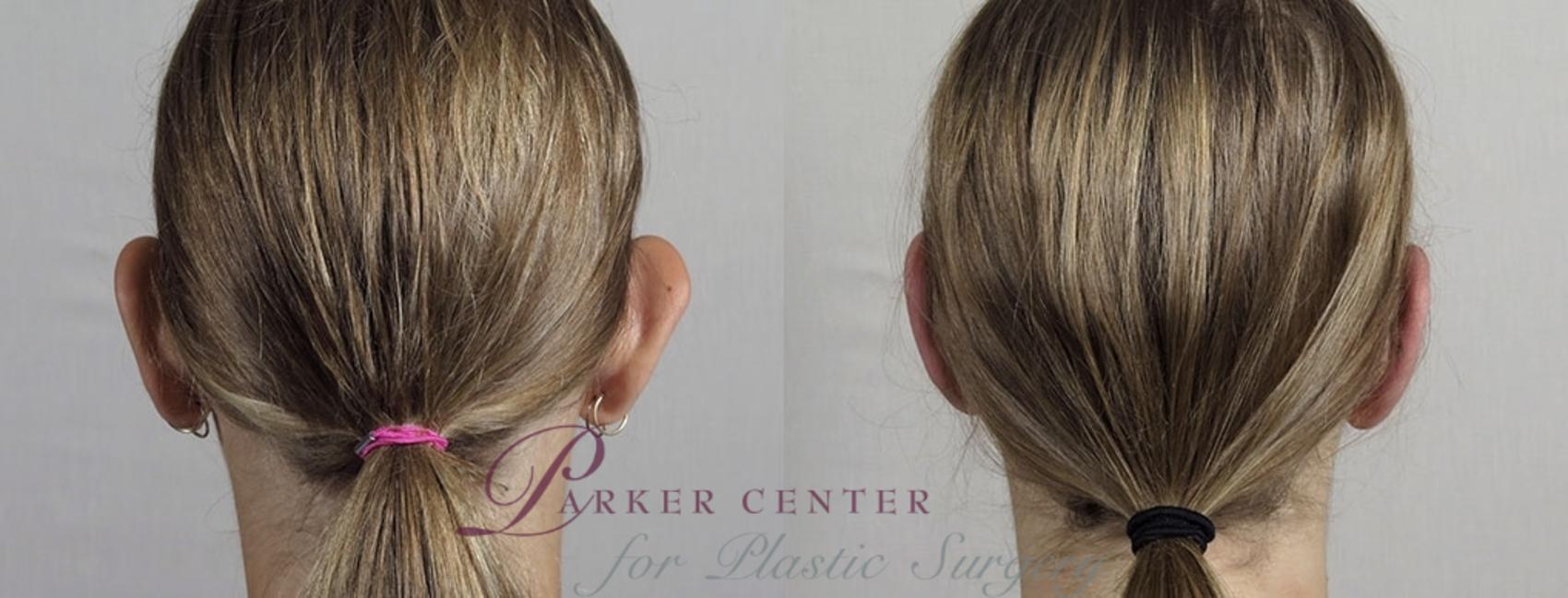 Ear Surgery Case 897 Before & After View #4 | Paramus, NJ | Parker Center for Plastic Surgery