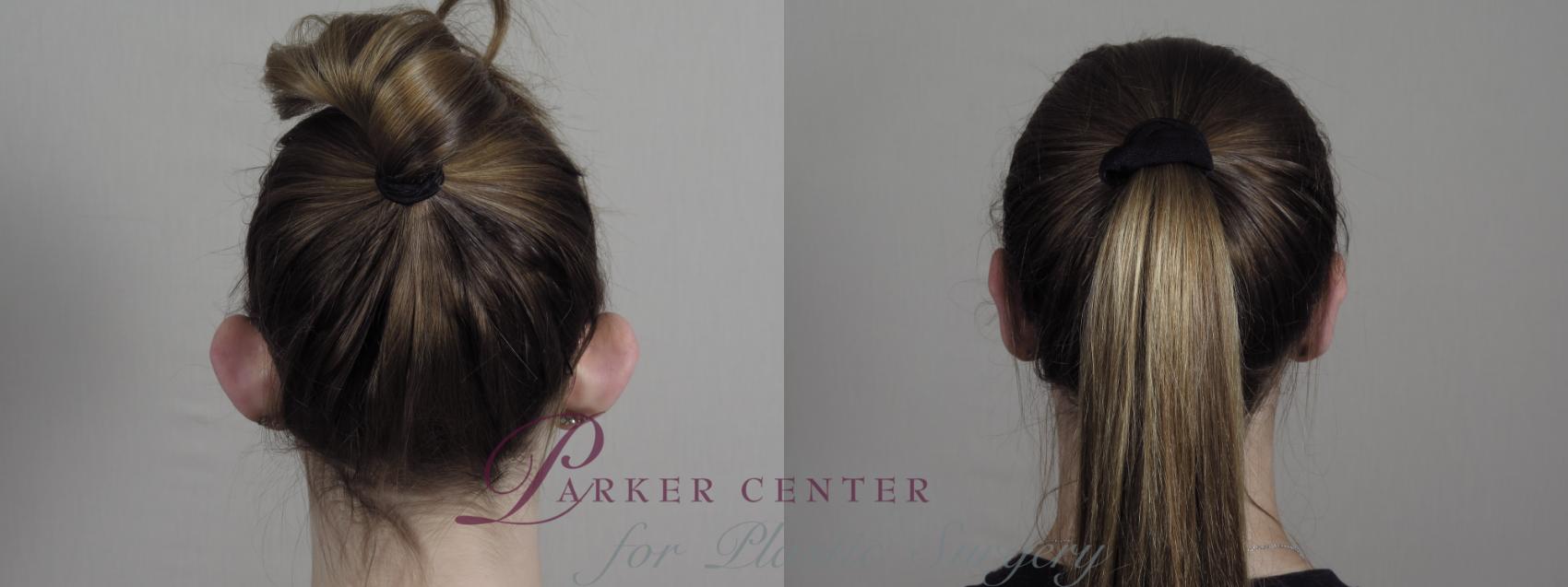 Ear Surgery Case 984 Before & After Back | Paramus, NJ | Parker Center for Plastic Surgery