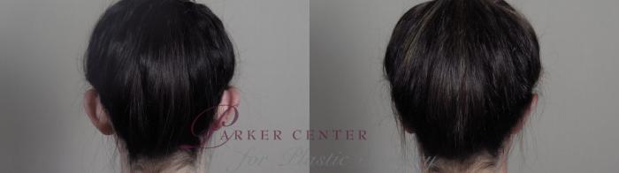 Ear Surgery Case 985 Before & After Back | Paramus, NJ | Parker Center for Plastic Surgery
