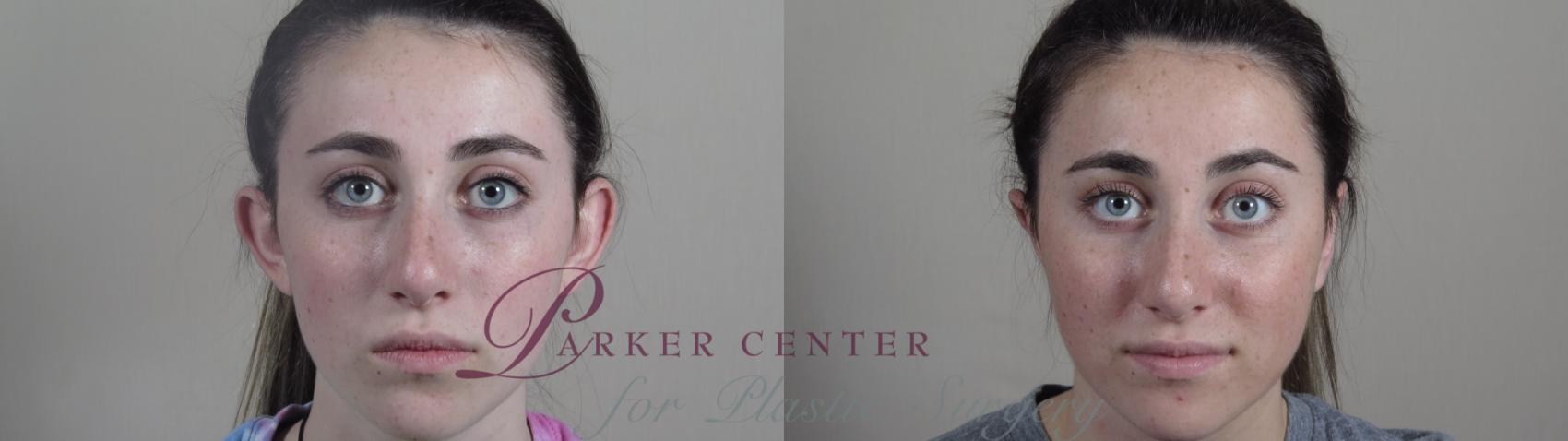 Ear Surgery Case 985 Before & After Front | Paramus, NJ | Parker Center for Plastic Surgery