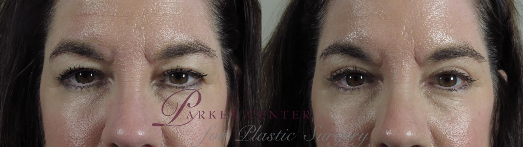 Eyelid Lift Case 1004 Before & After Front | Paramus, NJ | Parker Center for Plastic Surgery