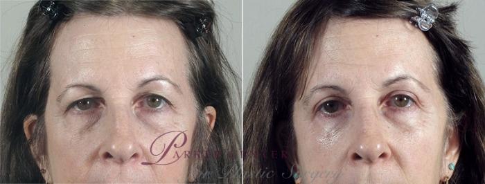 Eyelid Lift Case 101 Before & After View #1 | Paramus, NJ | Parker Center for Plastic Surgery