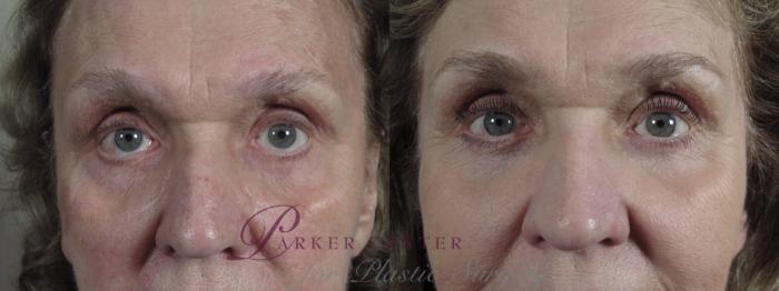 Eyelid Lift Case 1016 Before & After Close up eyes | Paramus, NJ | Parker Center for Plastic Surgery