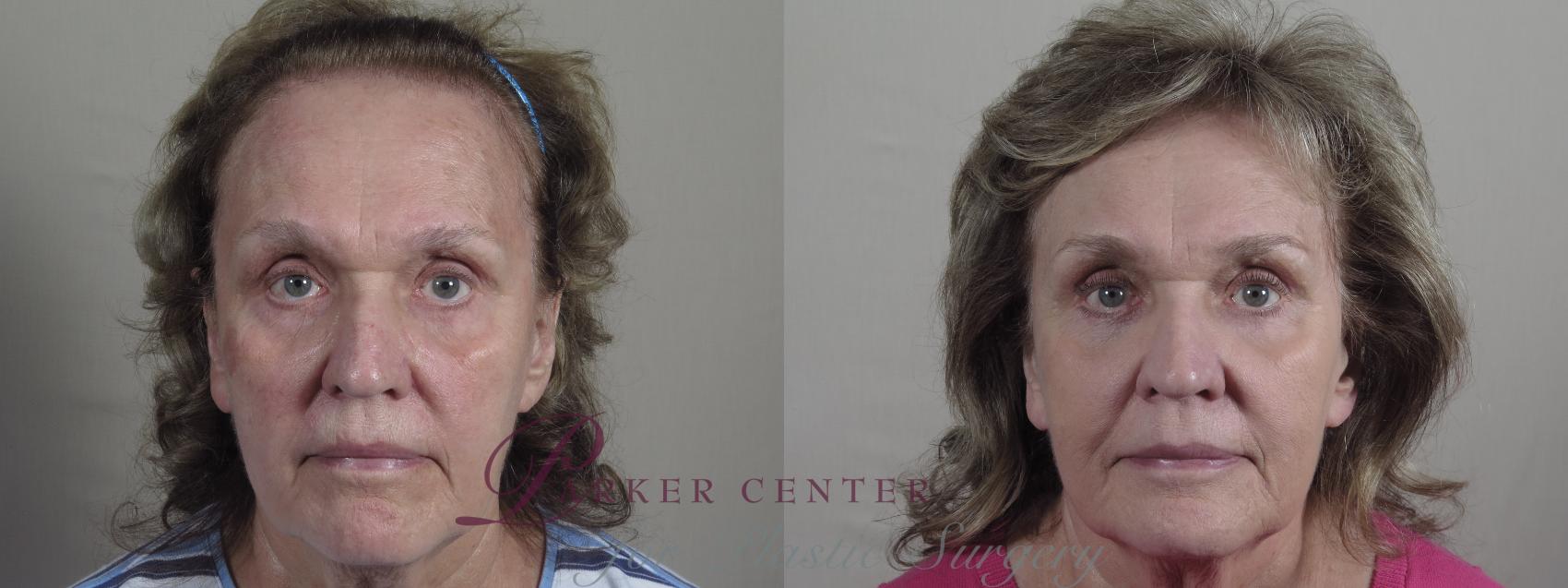 Eyelid Lift Case 1016 Before & After Front | Paramus, NJ | Parker Center for Plastic Surgery
