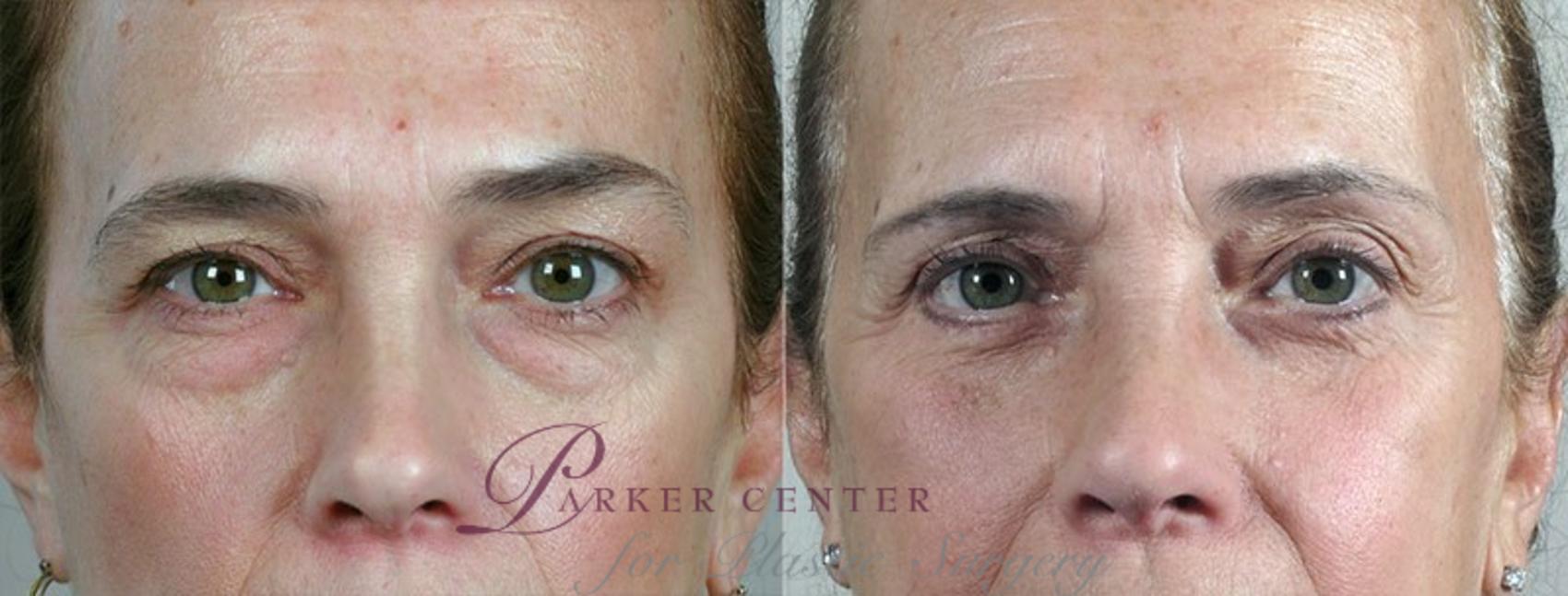 Eyelid Lift Case 102 Before & After View #1 | Paramus, NJ | Parker Center for Plastic Surgery