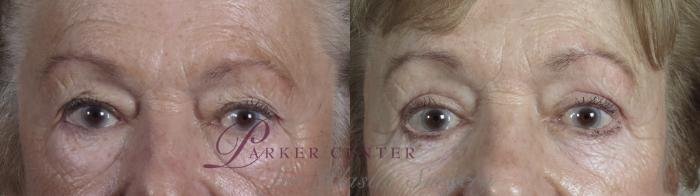 Eyelid Lift Case 1027 Before & After Front | Paramus, NJ | Parker Center for Plastic Surgery