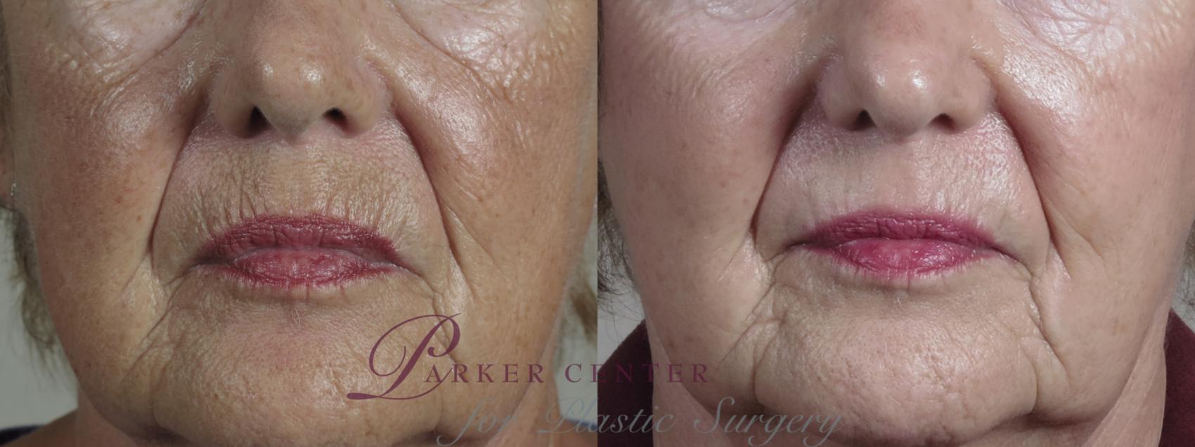 Eyelid Lift Case 1027 Before & After Mouth close up | Paramus, NJ | Parker Center for Plastic Surgery