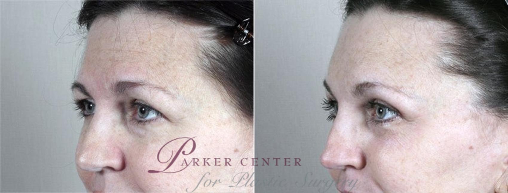 Nonsurgical Face Procedures Case 103 Before & After View #1 | Paramus, NJ | Parker Center for Plastic Surgery