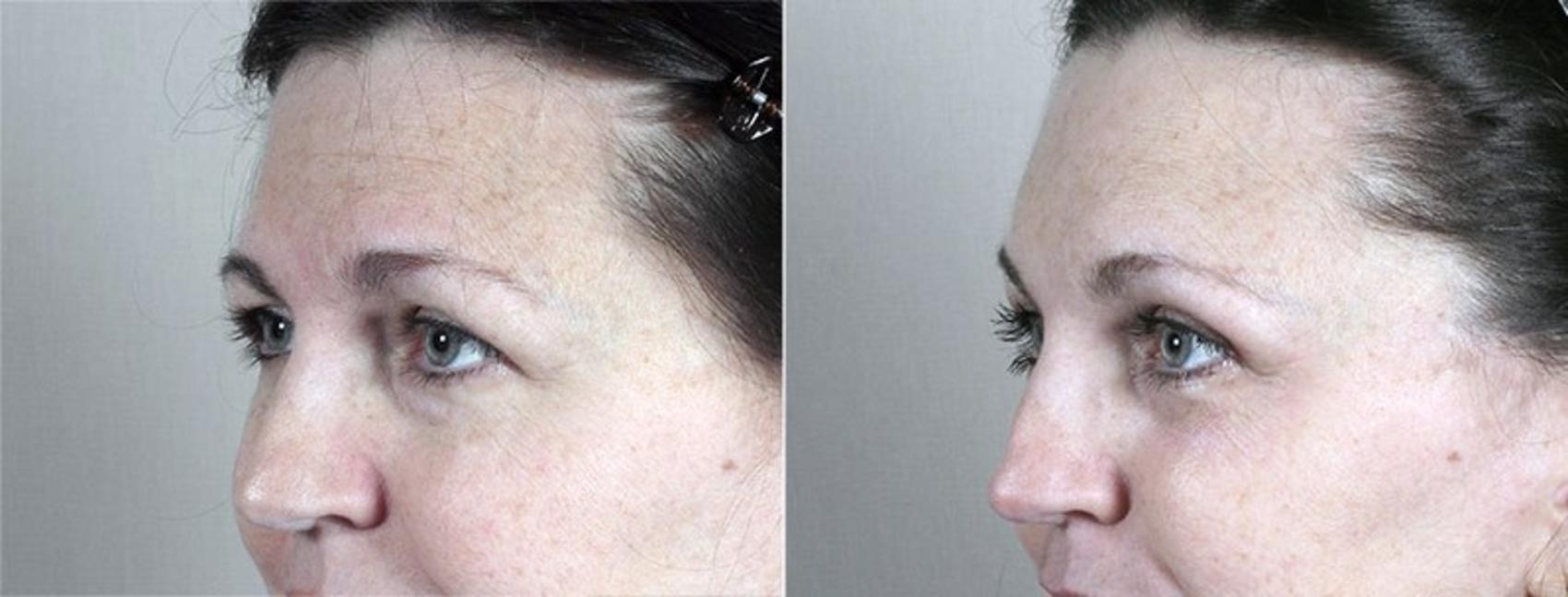 Brow Lift Case 103 Before & After View #1 | Paramus, NJ | Parker Center for Plastic Surgery