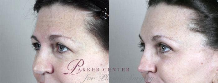 Eyelid Lift Case 103 Before & After View #1 | Paramus, NJ | Parker Center for Plastic Surgery