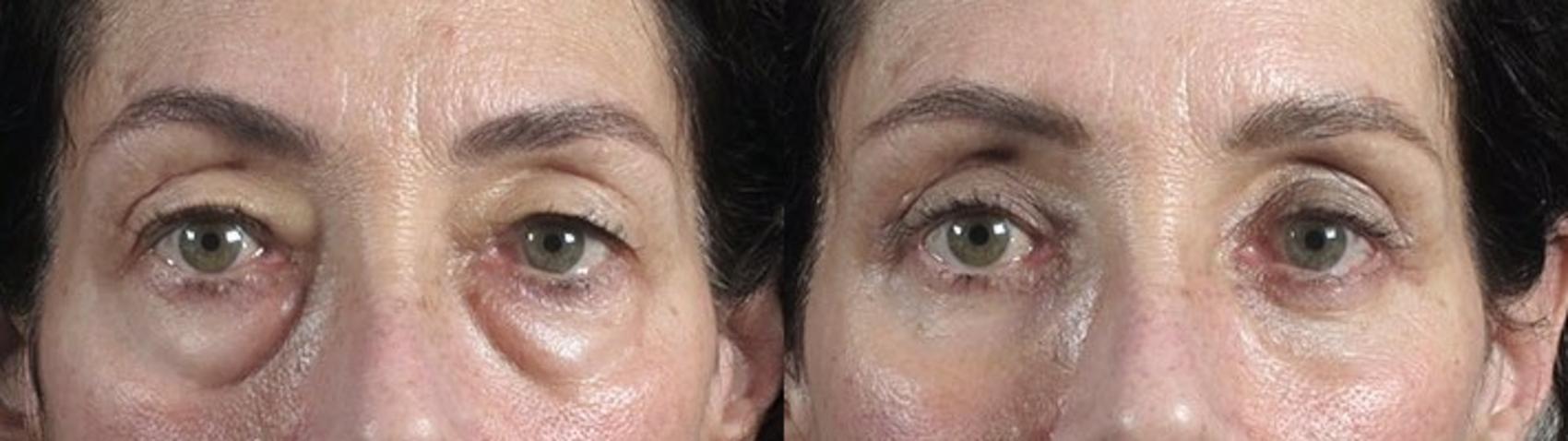 Eyelid Lift Case 104 Before & After View #1 | Paramus, New Jersey | Parker Center for Plastic Surgery