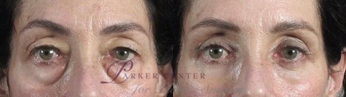 Eyelid Lift Case 104 Before & After View #1 | Paramus, NJ | Parker Center for Plastic Surgery