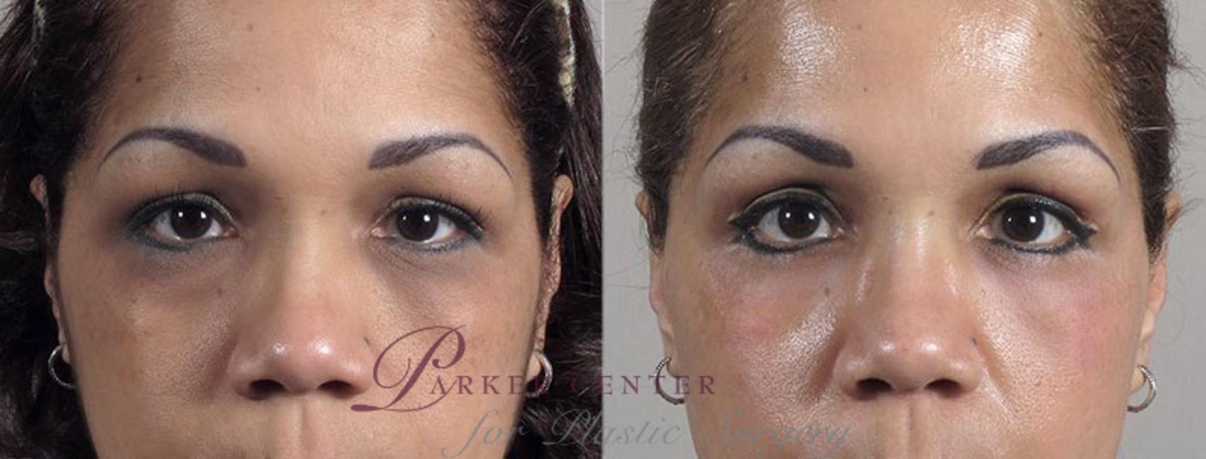 Eyelid Lift Case 105 Before & After View #1 | Paramus, NJ | Parker Center for Plastic Surgery
