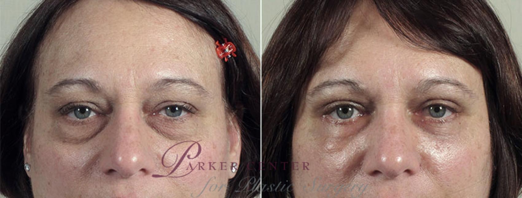 Eyelid Lift Case 106 Before & After View #1 | Paramus, NJ | Parker Center for Plastic Surgery