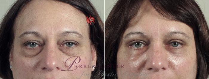 Eyelid Lift Case 106 Before & After View #1 | Paramus, NJ | Parker Center for Plastic Surgery