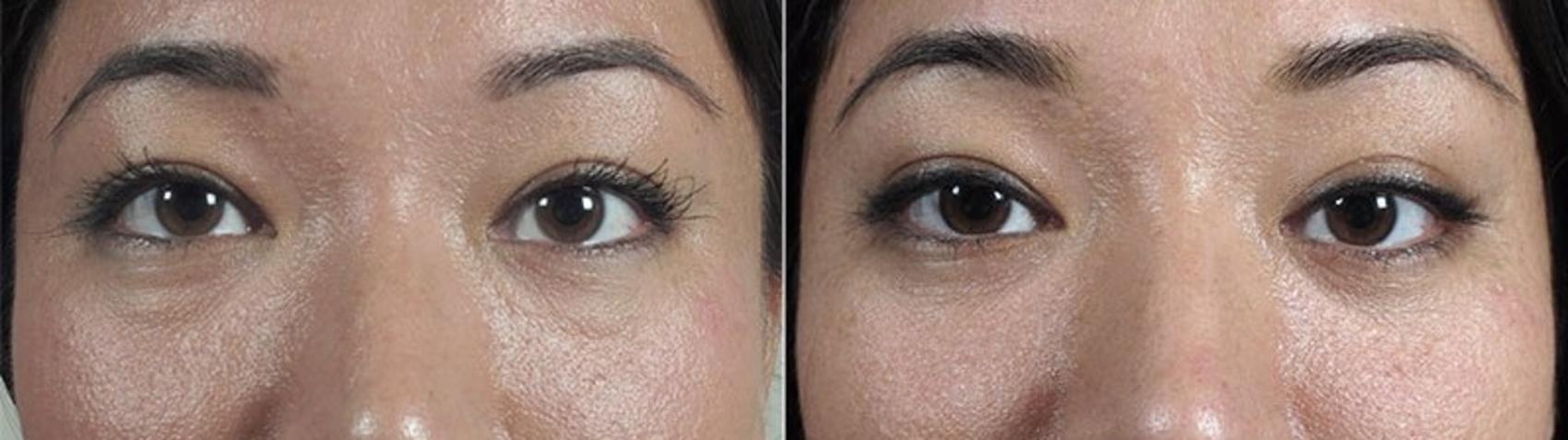 Eyelid Lift Case 108 Before & After View #1 | Paramus, NJ | Parker Center for Plastic Surgery