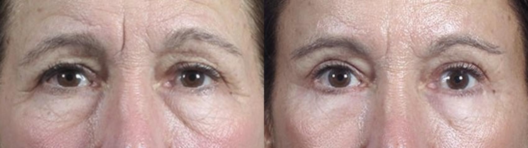 Eyelid Lift Case 109 Before & After View #1 | Paramus, NJ | Parker Center for Plastic Surgery