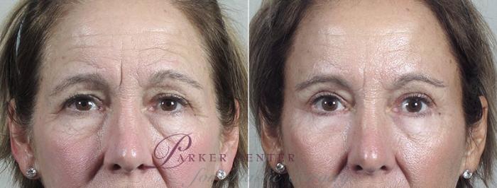Eyelid Lift Case 109 Before & After View #1 | Paramus, NJ | Parker Center for Plastic Surgery