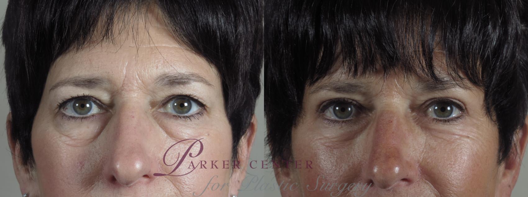 Eyelid Lift Case 1091 Before & After Front | Paramus, NJ | Parker Center for Plastic Surgery