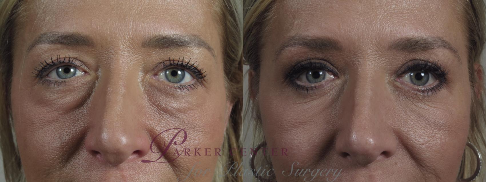 Eyelid Lift Case 1092 Before & After Close up eyes | Paramus, NJ | Parker Center for Plastic Surgery