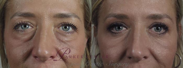 Eyelid Lift Case 1092 Before & After Close up eyes | Paramus, NJ | Parker Center for Plastic Surgery