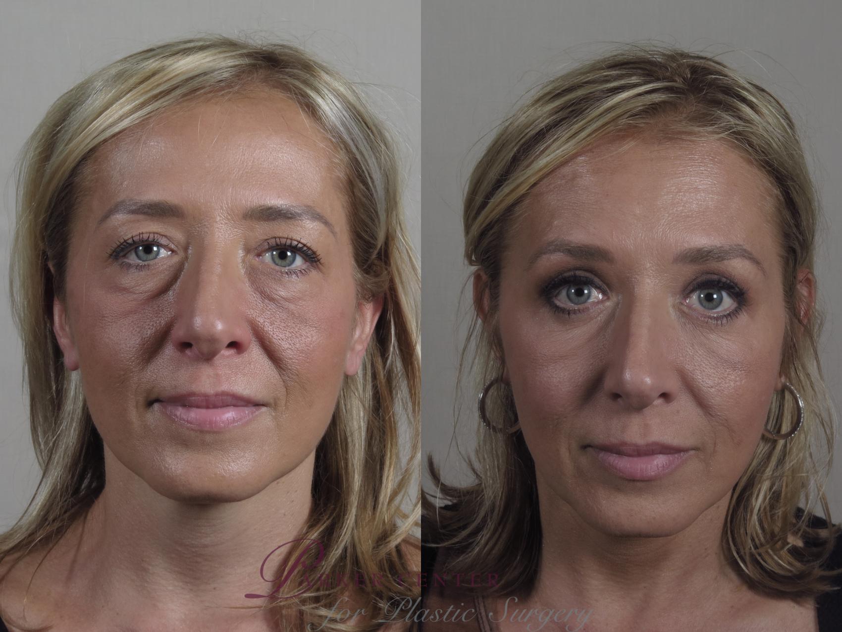 Eyelid Lift Case 1092 Before & After Front | Paramus, NJ | Parker Center for Plastic Surgery