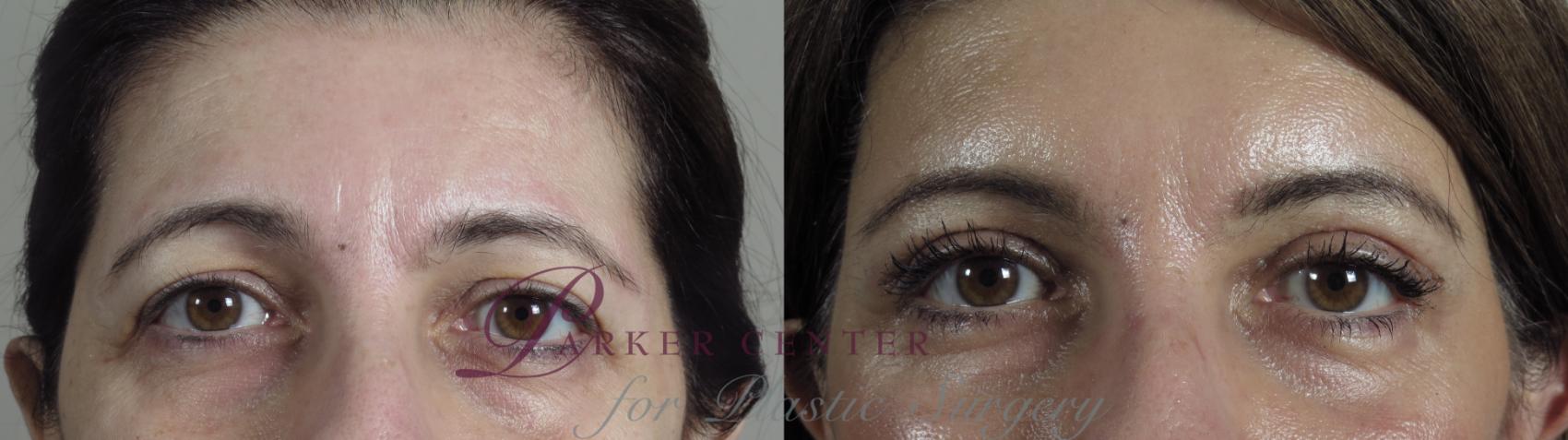 Eyelid Lift Case 1093 Before & After Front | Paramus, NJ | Parker Center for Plastic Surgery