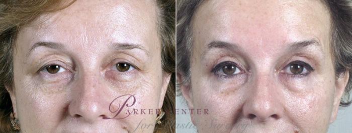Eyelid Lift Case 110 Before & After View #1 | Paramus, NJ | Parker Center for Plastic Surgery