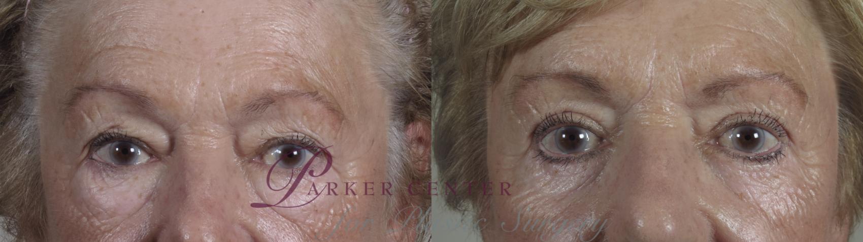 Eyelid Lift Case 1100 Before & After Front | Paramus, NJ | Parker Center for Plastic Surgery