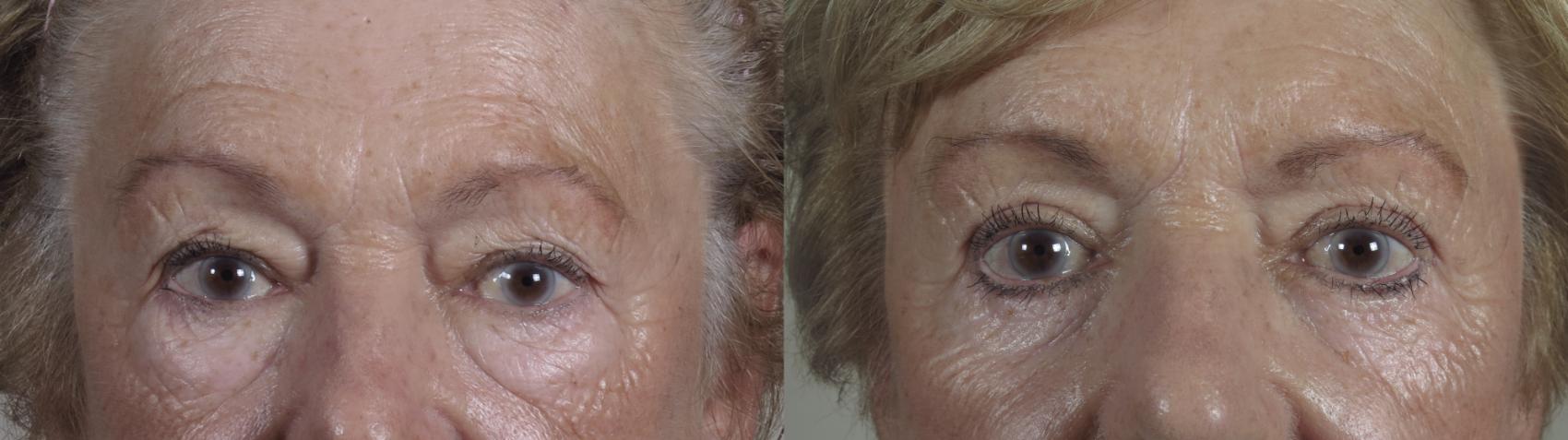 Eyelid Lift Case 1100 Before & After Front | Paramus, New Jersey | Parker Center for Plastic Surgery