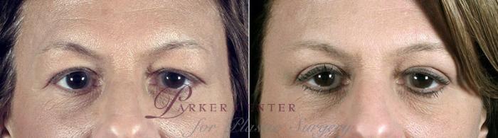 Eyelid Lift Case 111 Before & After View #2 | Paramus, NJ | Parker Center for Plastic Surgery