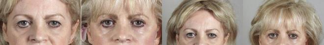 Eyelid Lift Case 1112 Before & After Front | Paramus, NJ | Parker Center for Plastic Surgery