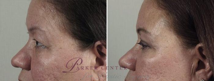 Eyelid Lift Case 1169 Before & After View 2 | Paramus, NJ | Parker Center for Plastic Surgery