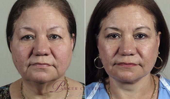 Eyelid Lift Case 1169 Before & After View 3 | Paramus, NJ | Parker Center for Plastic Surgery