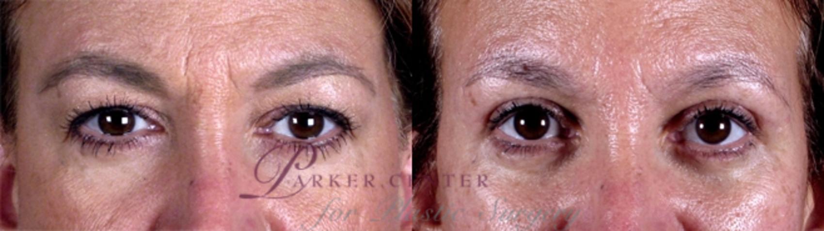 Eyelid Lift Case 1173 Before & After View 1  | Paramus, NJ | Parker Center for Plastic Surgery